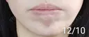 ボトックス（あご） 湘南美容クリニック 宇都宮院 DAY 15 サムネイル用
