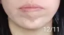 ボトックス（あご） 湘南美容クリニック 宇都宮院 DAY 16 サムネイル用