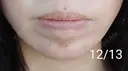 ボトックス（あご） 湘南美容クリニック 宇都宮院 AFTER サムネイル用