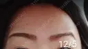 ボトックス（額） 湘南美容クリニック 宇都宮院 DAY 10 サムネイル用