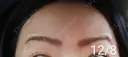 ボトックス（額） 湘南美容クリニック 宇都宮院 DAY 13 サムネイル用