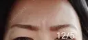 ボトックス（眉間） / その他（肌） 湘南美容クリニック 宇都宮院 DAY 10 サムネイル用