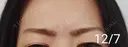 ボトックス（眉間） / その他（肌） 湘南美容クリニック 宇都宮院 DAY 12 サムネイル用