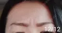 ボトックス（眉間） / その他（肌） 湘南美容クリニック 宇都宮院 DAY 17 サムネイル用
