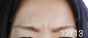 ボトックス（眉間） / その他（肌） 湘南美容クリニック 宇都宮院 AFTER サムネイル用