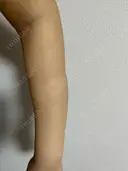 脂肪吸引（二の腕） / 脂肪吸引（背中） / 脂肪吸引（肩） 湘南美容クリニック 京都院 DAY 5 サムネイル用