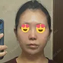 鼻尖形成（切開） / 小鼻縮小（切開） / 脂肪吸引（顔） / 軟骨移植 / 骨切幅寄せ / 鼻尖縮小 / 鼻柱挙上 銀座マイアミ美容外科 DAY 10 サムネイル用