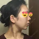 鼻尖形成（切開） / 小鼻縮小（切開） / 脂肪吸引（顔） / 軟骨移植 / 骨切幅寄せ / 鼻尖縮小 / 鼻柱挙上 銀座マイアミ美容外科 DAY 10 サムネイル用