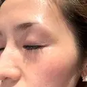 光治療（フォトフェイシャルなど） メディアージュクリニック 青山院 DAY 0 サムネイル用