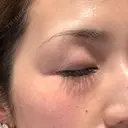 光治療（フォトフェイシャルなど） メディアージュクリニック 青山院 DAY 0 サムネイル用