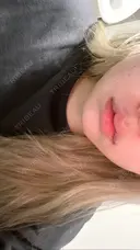 ヒアルロン酸注入（唇） 心斎橋形成外科スキンケアクリニック AFTER サムネイル用
