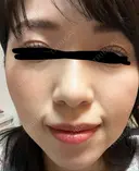 イオン導入 椿クリニック 名古屋院 DAY 10 サムネイル用