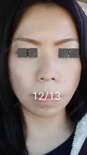 ハイフ（顔） / ハイフ（首） 湘南美容クリニック 宇都宮院 AFTER サムネイル用