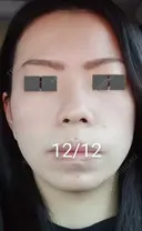 ハイフ（顔） / ハイフ（首） 湘南美容クリニック 宇都宮院 DAY 17 サムネイル用