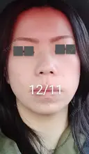 ハイフ（顔） / ハイフ（首） 湘南美容クリニック 宇都宮院 DAY 16 サムネイル用