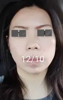 ハイフ（顔） / ハイフ（首） 湘南美容クリニック 宇都宮院 DAY 15 サムネイル用