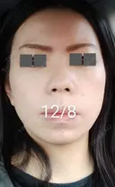 ハイフ（顔） / ハイフ（首） 湘南美容クリニック 宇都宮院 DAY 13 サムネイル用