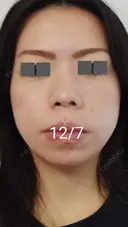 ハイフ（顔） / ハイフ（首） 湘南美容クリニック 宇都宮院 DAY 12 サムネイル用