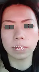 ハイフ（顔） / ハイフ（首） 湘南美容クリニック 宇都宮院 DAY 11 サムネイル用