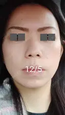 ハイフ（顔） / ハイフ（首） 湘南美容クリニック 宇都宮院 DAY 10 サムネイル用