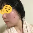 ほくろ・いぼ切除（肌） 甲府昭和形成外科クリニック AFTER サムネイル用