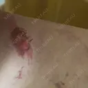 脂肪吸引（脚） / 豊胸（脂肪注入） S.T styleクリニック DAY 8 サムネイル用