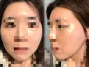 脂肪注入（額） GRACIA clinic 【グラシアクリニック】 DAY 43 サムネイル用