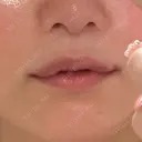 ヒアルロン酸注入（唇） / ヒアルロン酸注入（額） / ヒアルロン酸注入（頬） / ヒアルロン酸注入（こめかみ） ziz CLINIC AFTER サムネイル用