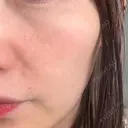 ピコレーザートーニング（美白・肝斑） / フラクショナルレーザー（毛穴・ニキビ跡） おおかみ美容のクリニック 新宿院 AFTER サムネイル用