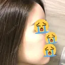 脂肪吸引（顔） / 額を丸く / 脂肪吸引（脚） / こめかみ形成 / 輪郭修正 / 脂肪注入（額） / 脂肪注入（輪郭） フレッシュ整形外科 DAY 25 サムネイル用