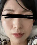 イオン導入 椿クリニック 名古屋院 DAY 12 サムネイル用