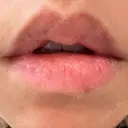 シミ取りレーザー Jスキンクリニック 【J-SKIN clinic】 DAY 7 サムネイル用