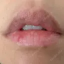 シミ取りレーザー Jスキンクリニック 【J-SKIN clinic】 DAY 9 サムネイル用