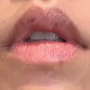 シミ取りレーザー Jスキンクリニック 【J-SKIN clinic】 DAY 11 サムネイル用
