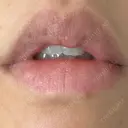 シミ取りレーザー Jスキンクリニック 【J-SKIN clinic】 DAY 22 サムネイル用