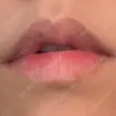 シミ取りレーザー Jスキンクリニック 【J-SKIN clinic】 AFTER サムネイル用