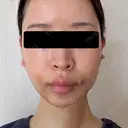 糸リフト / 脂肪吸引（顔） / ヒアルロン酸注入（あご） / ヒアルロン酸注入（こめかみ） BLINC CLINIC （ブリンク クリニック） DAY 2 サムネイル用