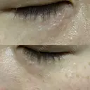 ニードルRF（ポテンツァなど） 表参道スキンクリニック 名古屋院（DAILY SKIN CLINIC提携院） DAY 2 サムネイル用