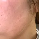 光治療（フォトフェイシャルなど） メディアージュクリニック 青山院 AFTER サムネイル用