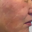 ポテンツァ ドクタープチ美容クリニック -江南店 DAY 0 サムネイル用