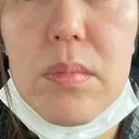 ポテンツァ ドクタープチ美容クリニック -江南店 AFTER サムネイル用