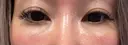 下まぶたの脂肪取り Brandnew Beauty Clinic DAY 8 サムネイル用