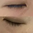 ニードルRF（ポテンツァなど） 表参道スキンクリニック 名古屋院（DAILY SKIN CLINIC提携院） DAY 3 サムネイル用