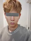 糸リフト / 脂肪吸引（顔） / ジョールファット除去 / 医療痩身（顔） / インディバ（顔） WOM CLINIC GINZA （ワム クリニック ギンザ） DAY 30 サムネイル用