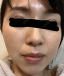 イオン導入 椿クリニック 名古屋院 DAY 14 サムネイル用