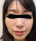 イオン導入 椿クリニック 名古屋院 DAY 15 サムネイル用