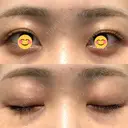 二重埋没 オーキッド美容クリニック東京御徒町 AFTER サムネイル用