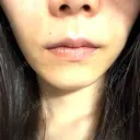 ヒアルロン酸注入（鼻翼基部） KAGA CLINIC DAY 1 サムネイル用