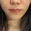 ヒアルロン酸注入（鼻翼基部） KAGA CLINIC DAY 4 サムネイル用