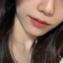 ヒアルロン酸注入（鼻翼基部） KAGA CLINIC AFTER サムネイル用